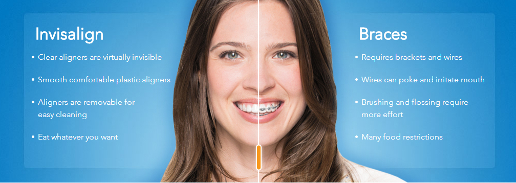 invisalign